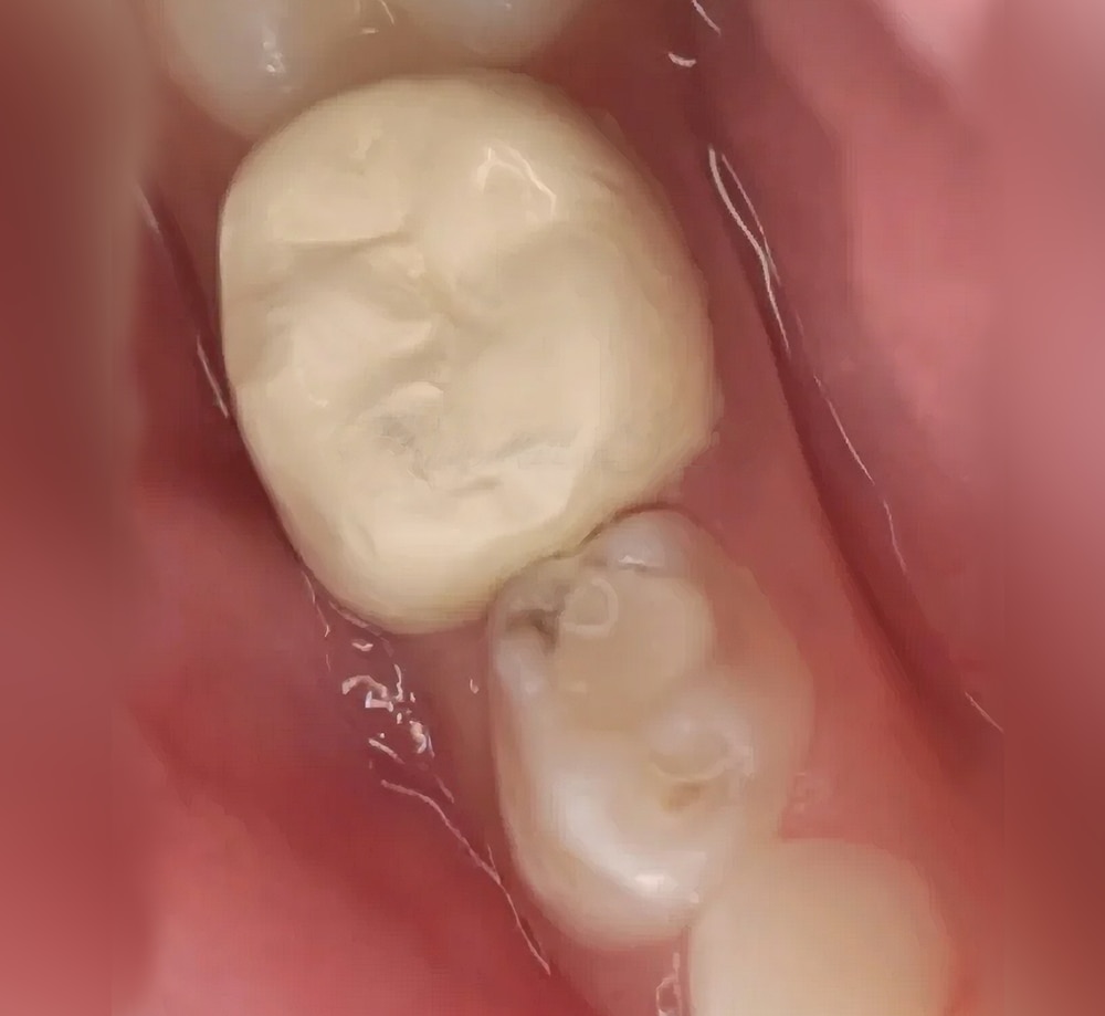 BioFlx clinical case by Milind Shah