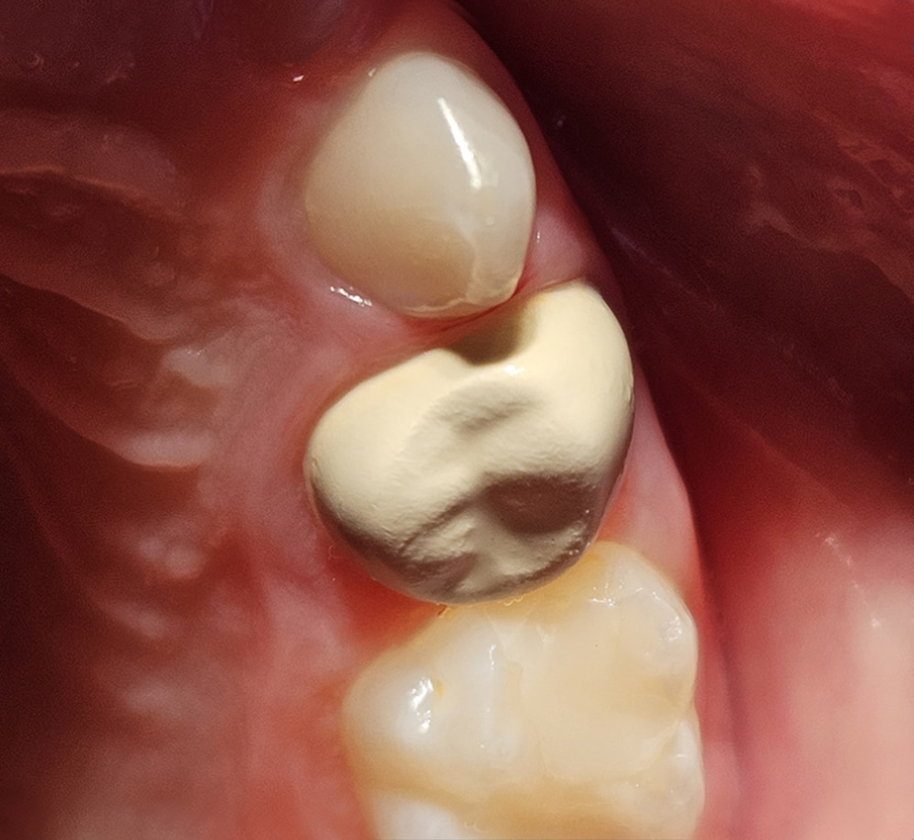 BioFlx clinical case by Jennifer Mai