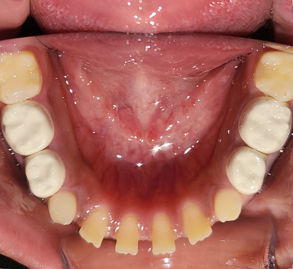 BioFlx clinical case by Paul Bahn