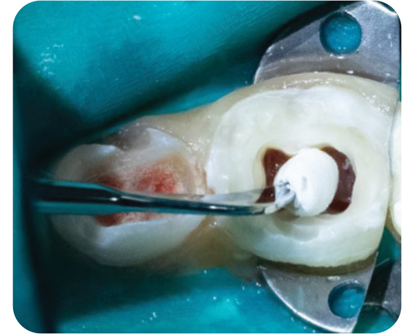NeoPUTTY dispensing step image one