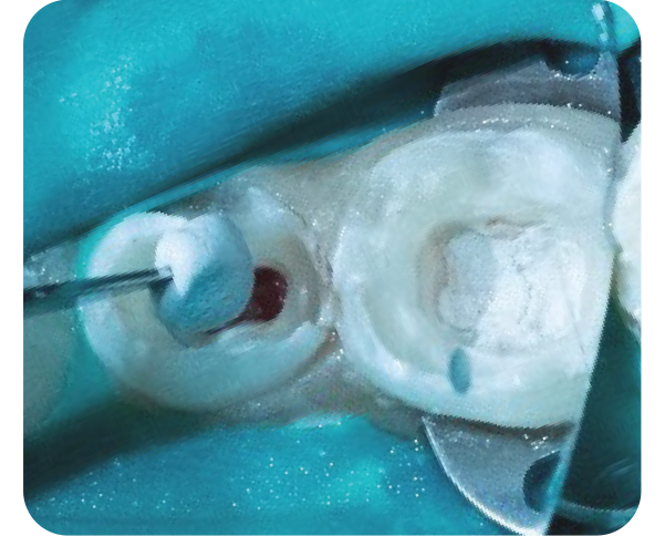 NeoPUTTY dispensing step image two