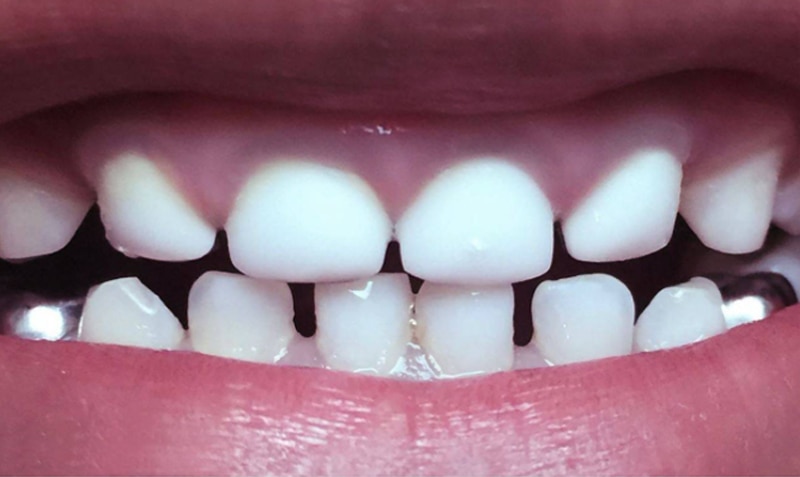 NuSmile Signature Crown case by Dr. Afsoon Elmore