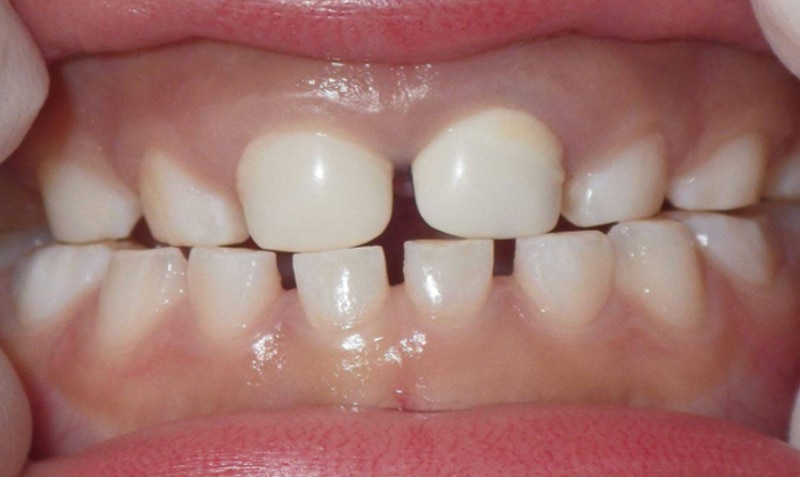 NuSmile Signature Crown case by Dr. Biance DeGuzman