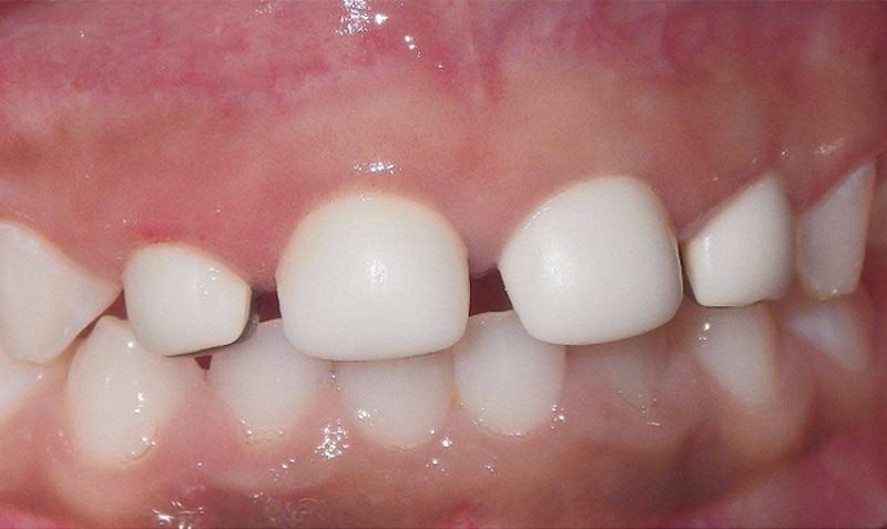 NuSmile Signature Crown case by Dr. Bill Waggoner, 3-year follow-up