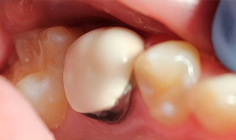 NuSmile Signature Crown case by Dr. Carla Cohn, 5-year follow-up