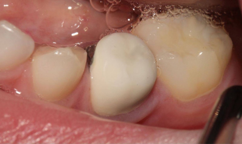 NuSmile Signature Crown case by Dr. Carla Cohn