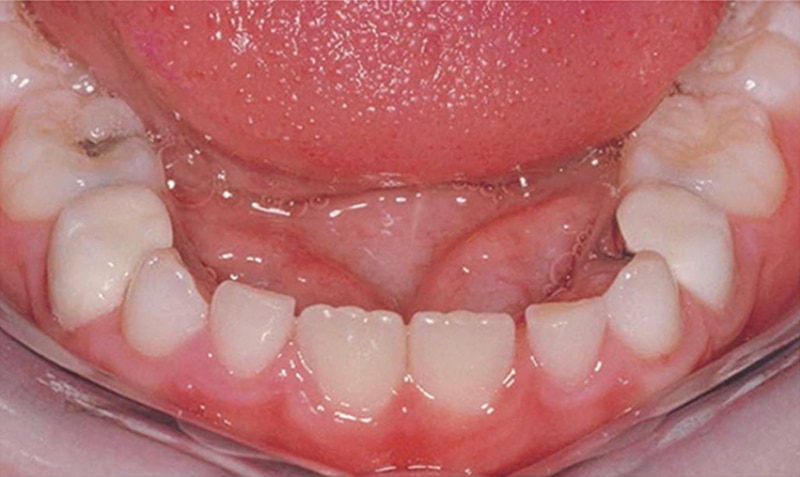 NuSmile Signature Crown clinical case