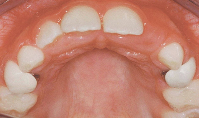 NuSmile Signature Crown clinical case