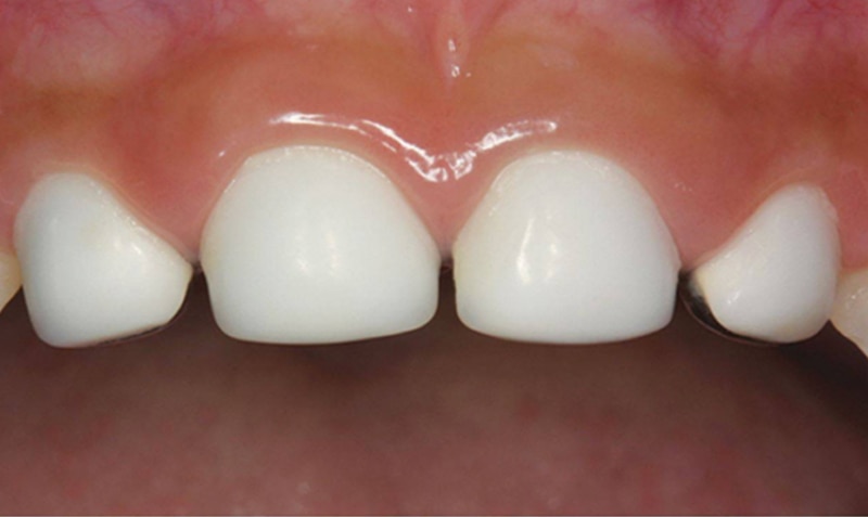 NuSmile Signature Crown case by Dr. Dane Hoang