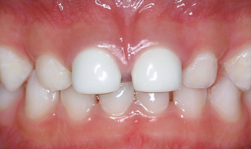 NuSmile Signature Crown case by Dr. Dane Hoang