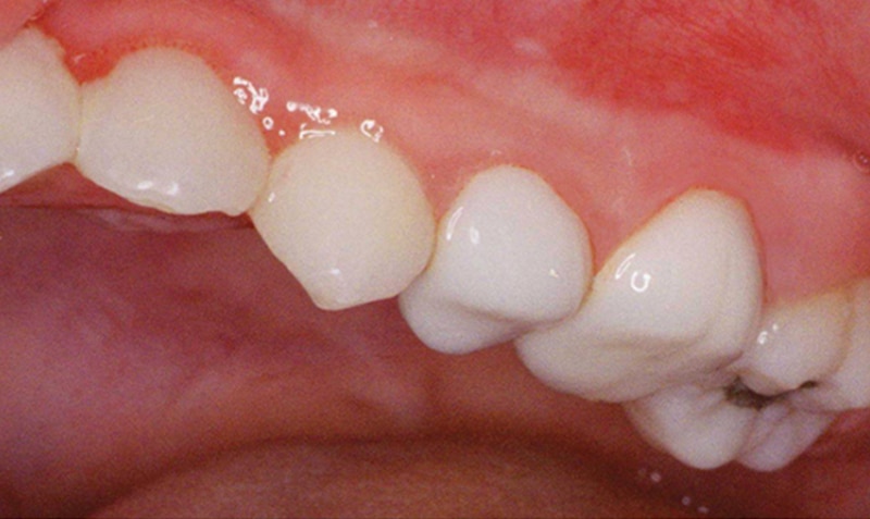 NuSmile Signature Crown case by Dr. Larry Caldwell