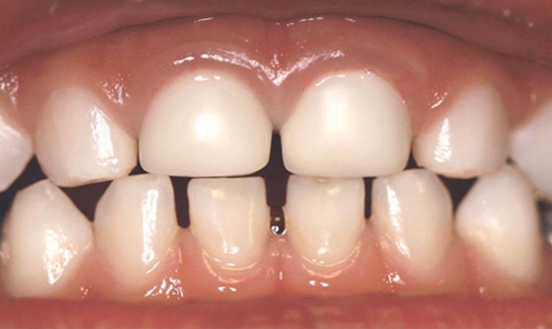NuSmile Signature Crown case from University of Nevada Las Vegas